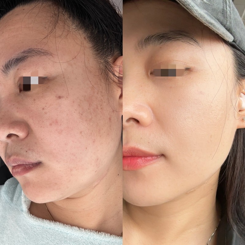 诺万娜全息疗肤调肤四件套！如果你的脸上有各种斑，痘痘，红血丝，大油田，敏感肌，大（第 6 张）