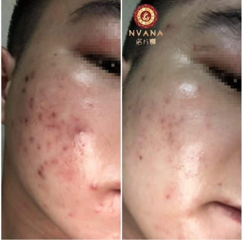 诺万娜全息疗肤调肤四件套！如果你的脸上有各种斑，痘痘，红血丝，大油田，敏感肌，大（第 9 张）